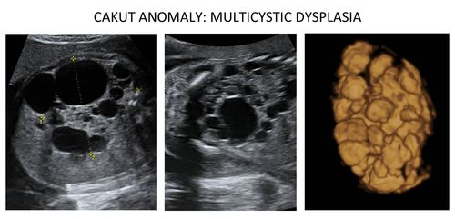 CAKUT Anomaly: Multicystic Dysplasia